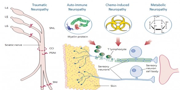 Neuropathic pain - ANS Biotech